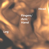 3D Ultrasound picture